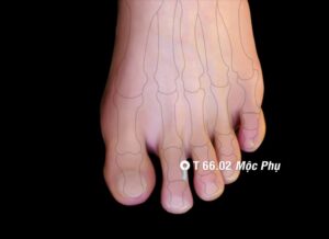 Huyệt Mộc phụ - châm cứu Đổng thị