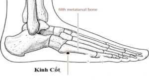 Huyệt kinh cốt