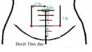 Huyệt thủy đạo 1