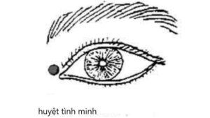 huyệt Tình minh